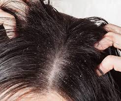 Simple Home Remedies For Dandruff Cure
