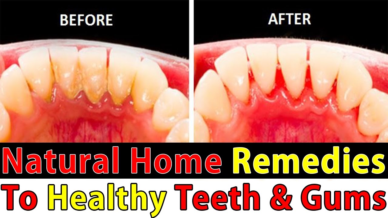 Home remedies for strong teeth