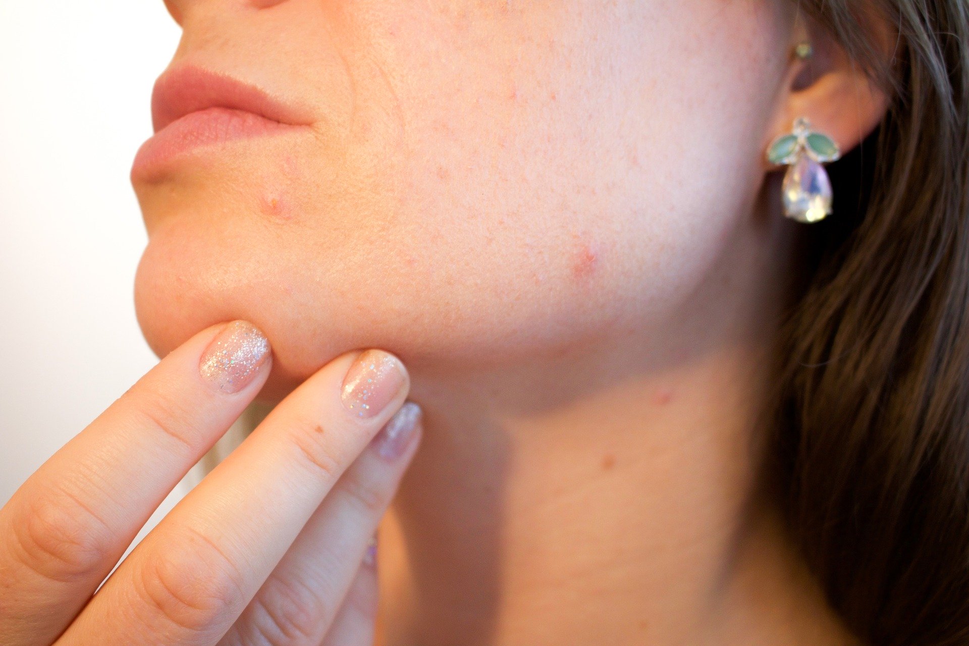 How to Get Rid of Acne Scars With Home Remedies