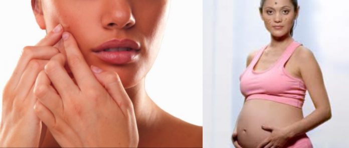 Prevent Pregnancy Acne