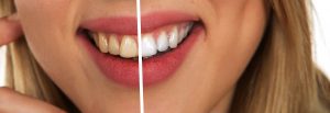 Natural teeth whitening