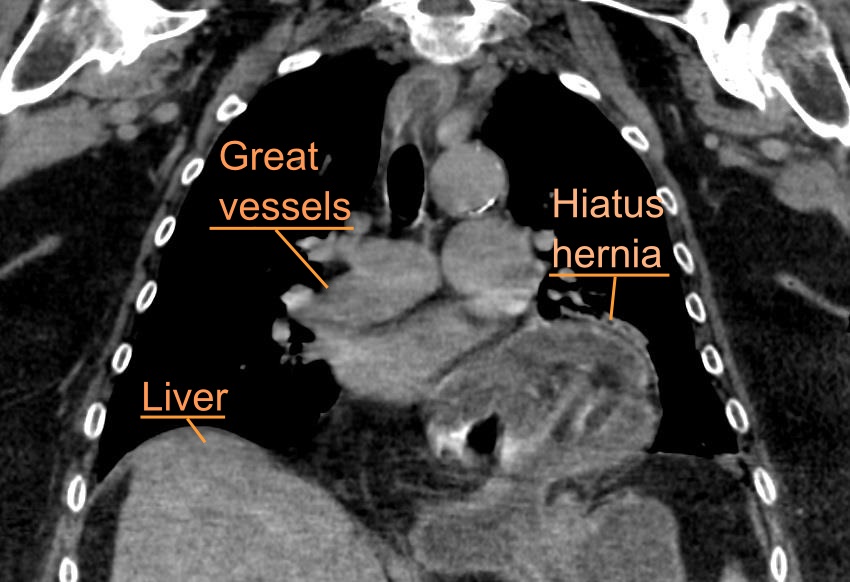 symptoms of a hiatal hernia