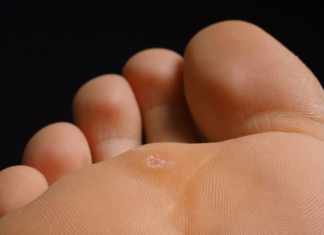 How to Identify Warts on Your Feet and Treat Them