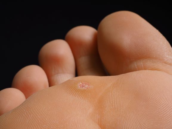 How to Identify Warts on Your Feet and Treat Them