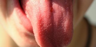 cracks in tongue