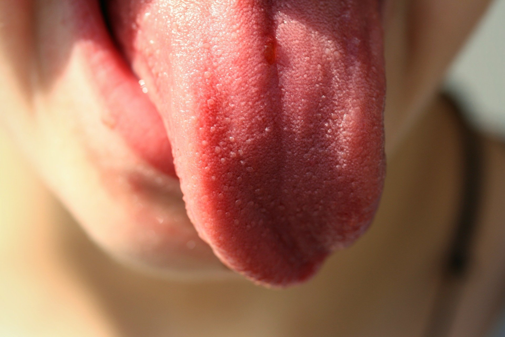 cracks in tongue
